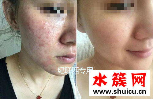 激素脸自己可以好吗 究竟激素脸怎样治疗好的快