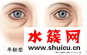 去眼袋多久恢复