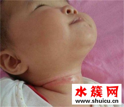 淹脖子用什么好的快